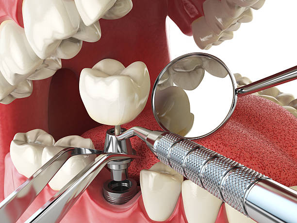 Best Emergency Tooth Extraction in White Meadow Lake, NJ